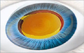 第4步:晶體展開手術(shù)完成