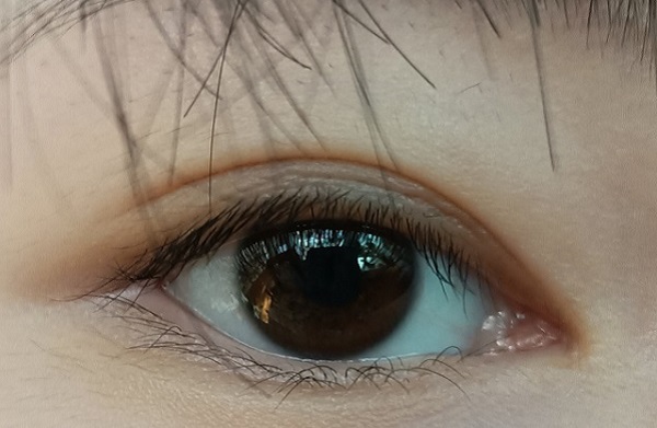 倒睫怎么辦？