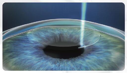 全飛秒激光手術