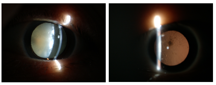 白內(nèi)障手術(shù)