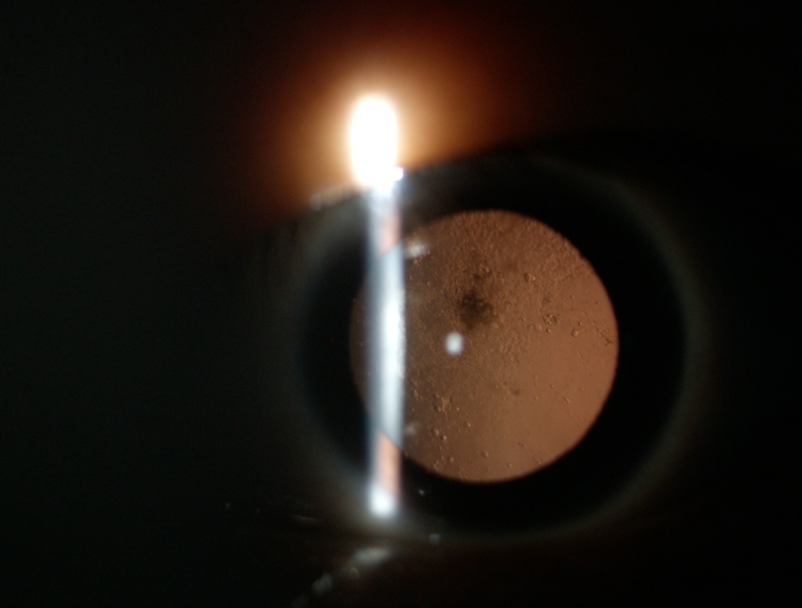 白內(nèi)障癥狀